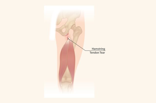Kas ve tendon bölgesini gösteren anatomik çizim