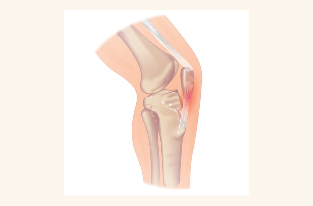 Diz ön yüzünde tendon bölgesini gösteren çizim