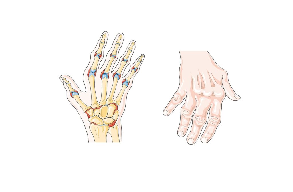 Romatoid artritte el eklemlerindeki değişimi gösteren çizim