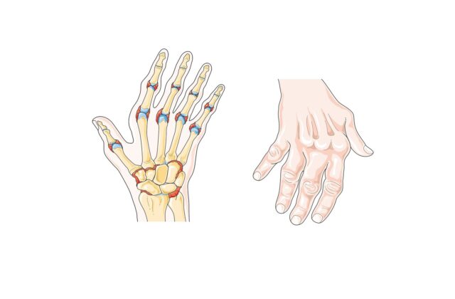 Romatoid artritte el eklemlerindeki değişimi gösteren çizim